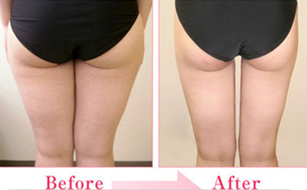 臀部抽脂有什么優(yōu)點(diǎn)？