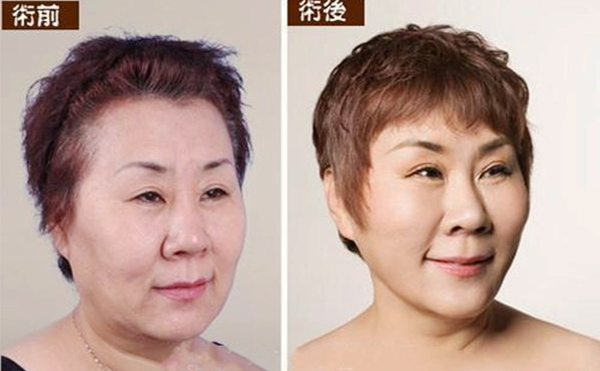 拉皮手術(shù)多久能恢復自然？