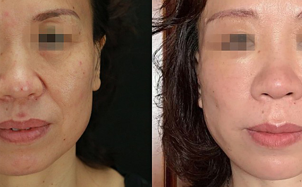 哪些人適合做拉皮手術(shù)？