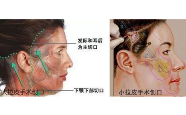 小拉皮和傳統(tǒng)拉皮有什么區(qū)別？