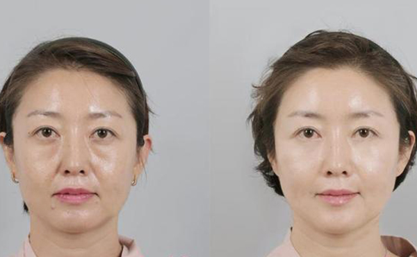 拉皮手術(shù)的過(guò)程是什么?術(shù)后需要注意什么?