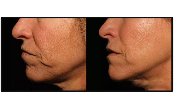 電波拉皮安全嗎？