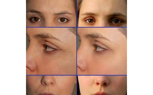 電波拉皮適合哪些人？