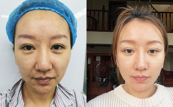 電波拉皮除皺效果能維持多久？