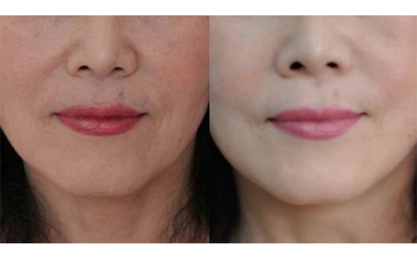 電波拉皮除皺后會(huì)腫脹嗎？