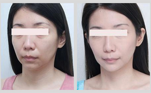 激光除皺是什么原理？