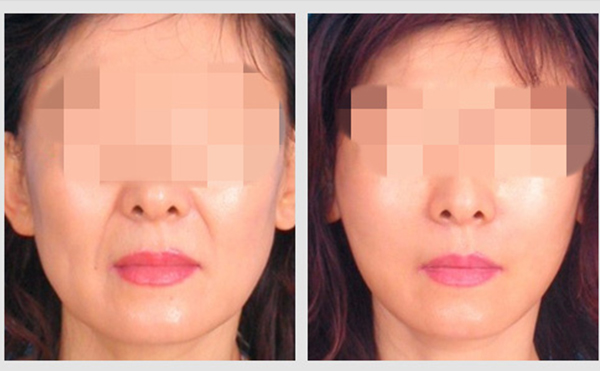 激光除皺需要做幾次才能出效果？