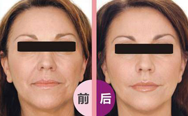 激光除皺會反彈嗎?