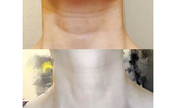 嗨體可以長期使用嗎？