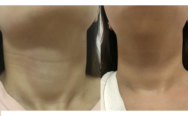 嗨體去頸紋會反彈嗎？