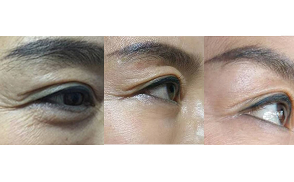 膠原蛋白除皺是什么原理？