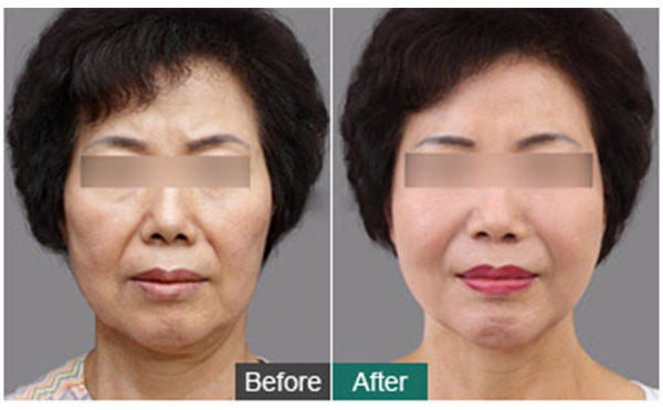 筋膜除皺提升有什么優(yōu)勢(shì)？