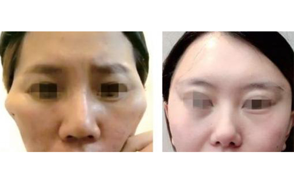 筋膜懸吊除皺有什么副作用？