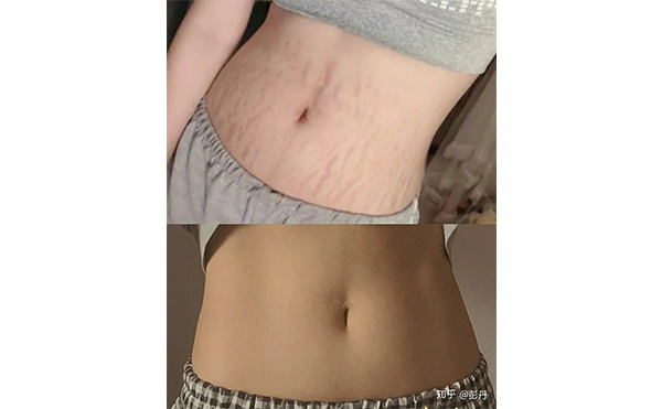 激光去妊娠紋安全嗎？