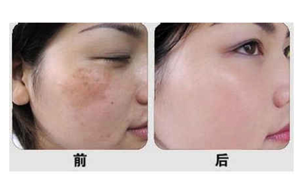 光子嫩膚有什么優(yōu)勢？