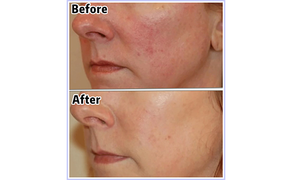 光子嫩膚會(huì)讓皮膚變薄嗎？