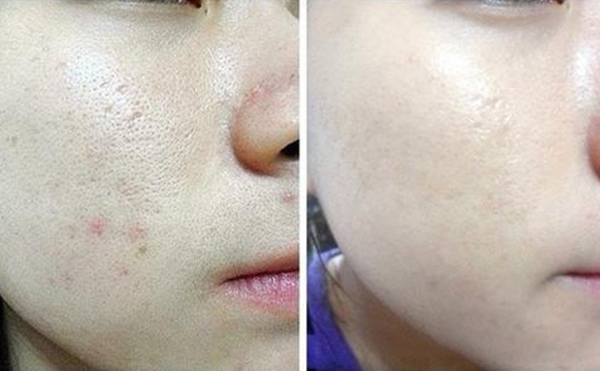 光子嫩膚的過程是什么?