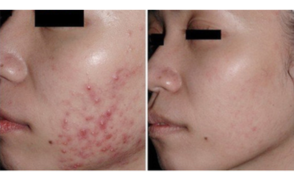 果酸煥膚好不好？