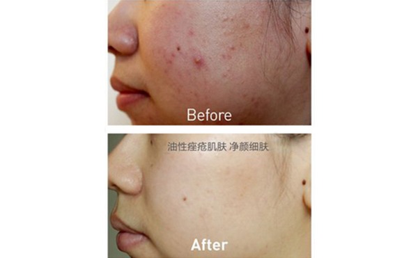 果酸煥膚能維持多久？