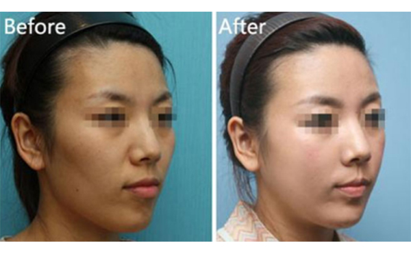 美白針一針多少錢？