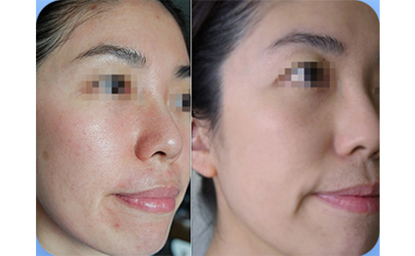 哪些人不是適合做水光針