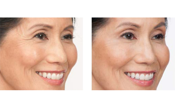 水光針適合哪個年齡段？