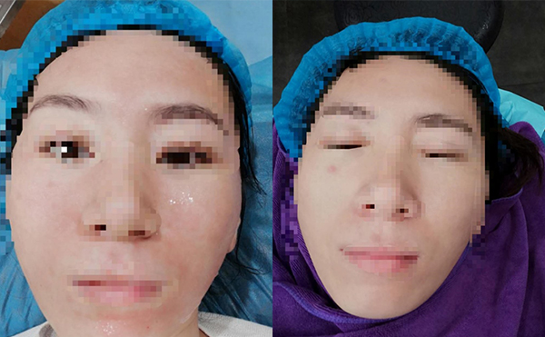 敏感肌能做水光針嗎？