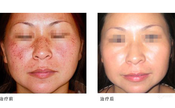 激光祛斑多少錢？