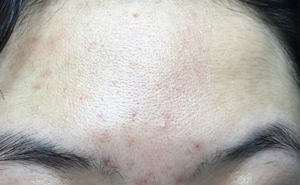 冰點(diǎn)脫毛有什么缺點(diǎn)嗎？