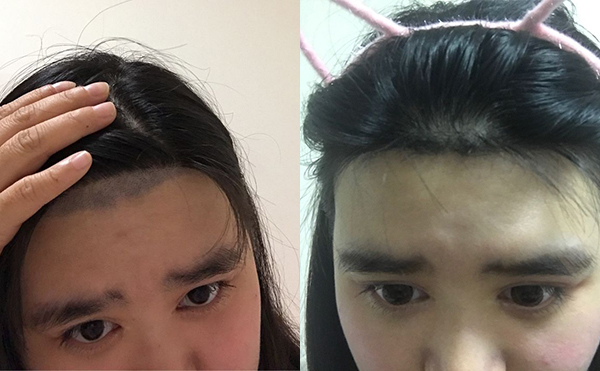 激光脫毛安全嗎？