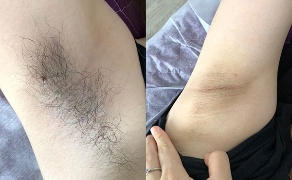 光子脫毛多少錢?價(jià)格跟哪些因素有關(guān)?