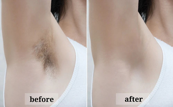 激光脫腋毛效果怎么樣？