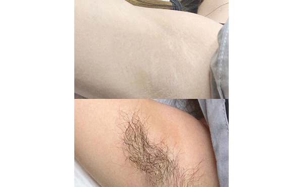 脫腋毛多少錢一次?價格很貴嗎?