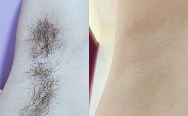 冰點(diǎn)脫腋毛要脫幾次？
