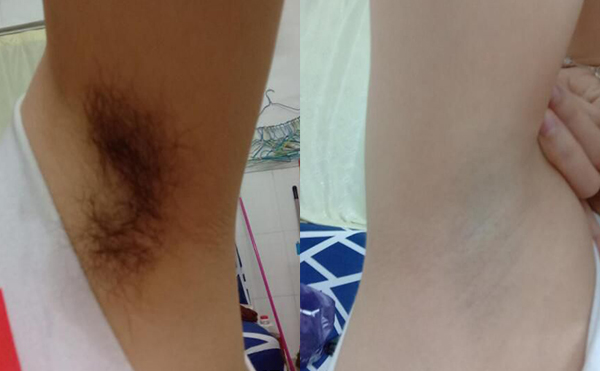 冰點脫腋毛過程是什么？