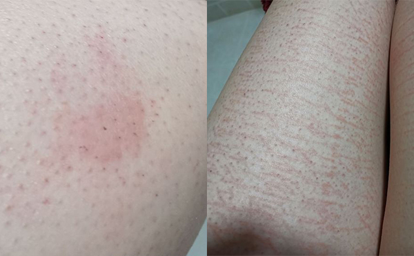 錯誤脫毛有什么后果?