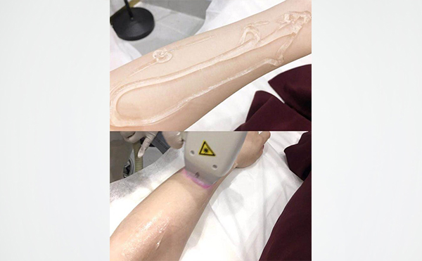 激光手臂脫毛是怎么做的？