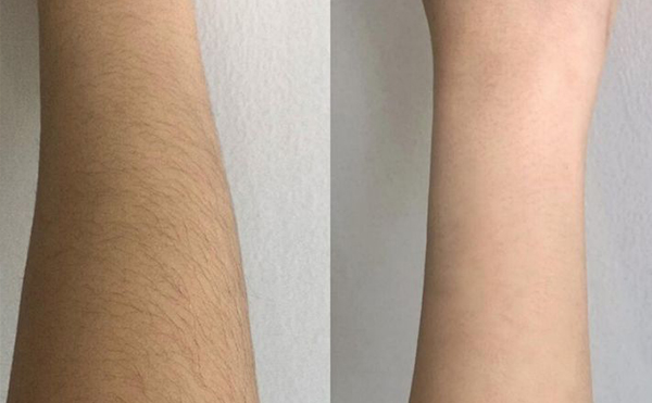 脫毛會影響新陳代謝嗎？