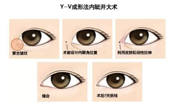 開(kāi)內(nèi)眼角復(fù)雜嗎?手術(shù)過(guò)程是什么?