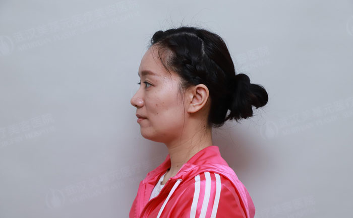 顴骨突出怎樣改善？