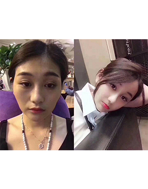 東方納米脂肪移植