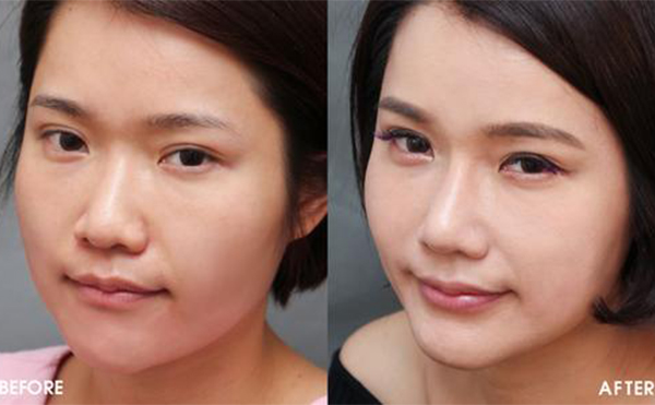 隆鼻手術(shù)怎么做效果會(huì)很好？