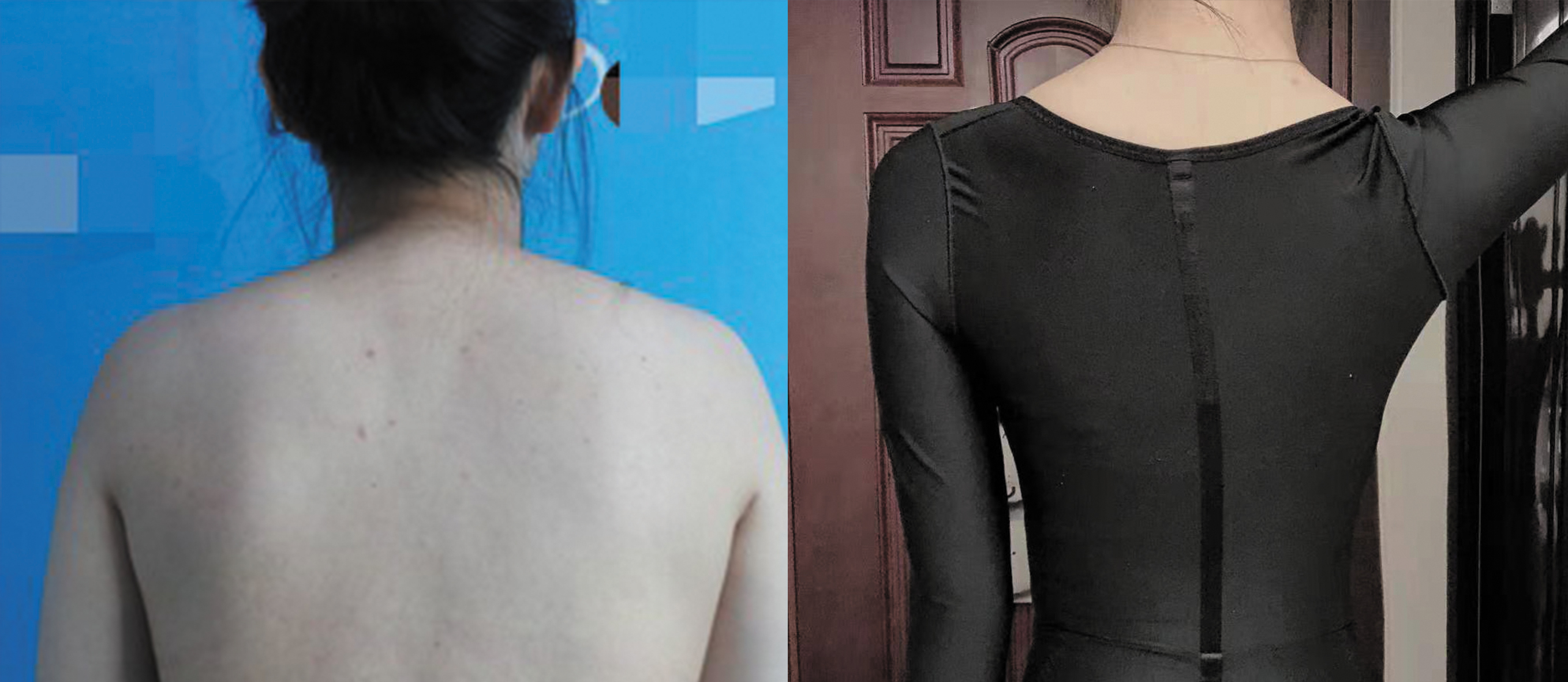 背部吸脂手術(shù)對比圖3