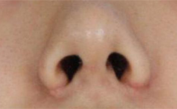 鼻翼缺損矯正手術方法