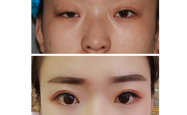 大小眼矯正多少錢?術(shù)后效果好不好?