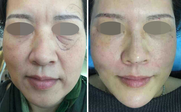 筋膜懸吊安全嗎？