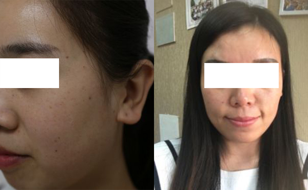 激光和光子嫩膚哪個(gè)祛斑效果好？怎么選擇？