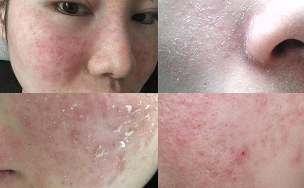 e光嫩膚有什么風險？