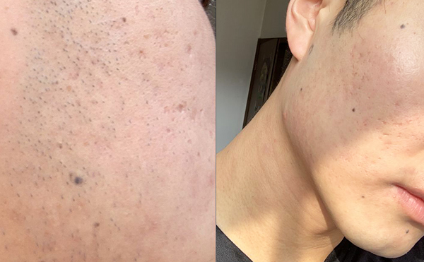 面部多毛是什么原因?qū)е碌?怎么去除?