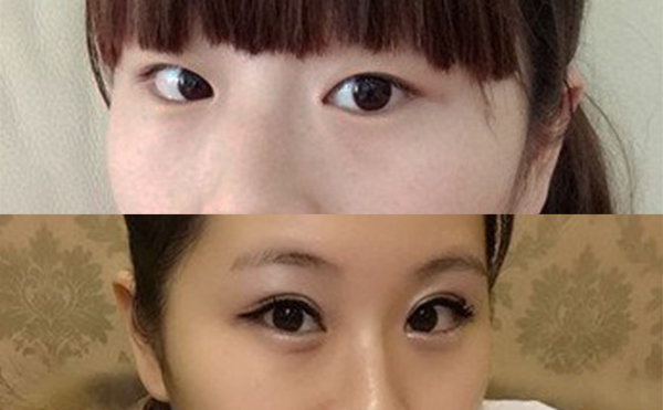 眼綜合安全嗎?有沒有什么并發(fā)癥?